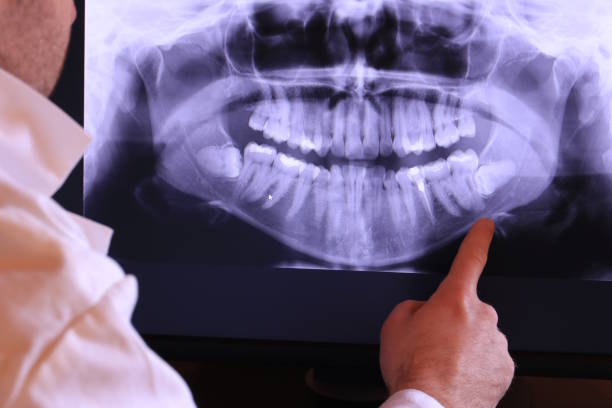 Best Emergency Wisdom Tooth Extraction in Albion, PA